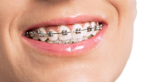 Лігатурні брекети